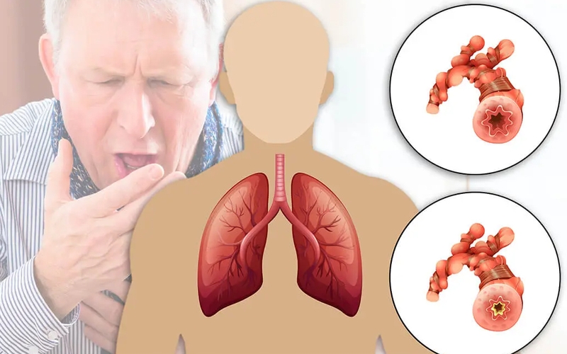 benh-copd-la-gi-tong-quan-ve-benh-ly-copd 1.jpg