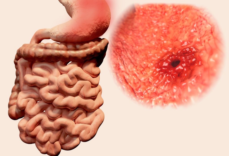 Bệnh Crohn nguy hiểm không? Người bị bệnh crohn sống được bao nhiêu năm? 1