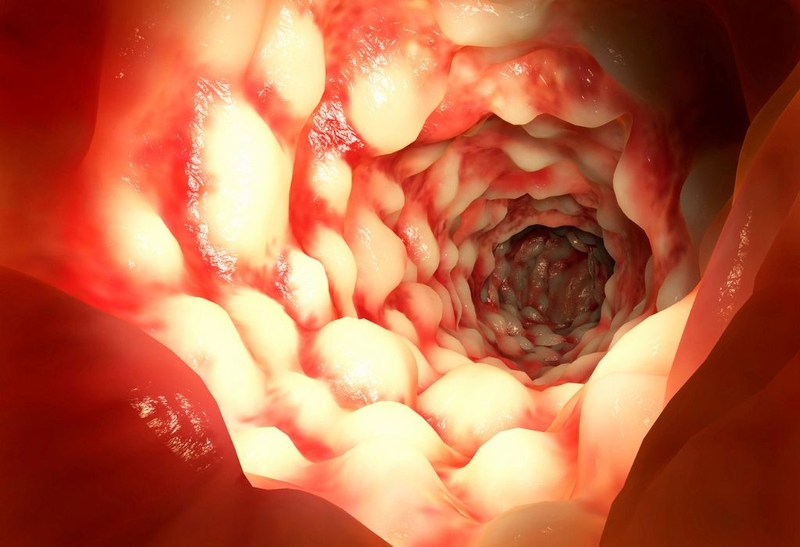 Bệnh Crohn nguy hiểm không? Người bị bệnh crohn sống được bao nhiêu năm? 3