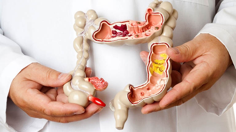 Bệnh Crohn ở trẻ em là một bệnh viêm ruột mãn tính