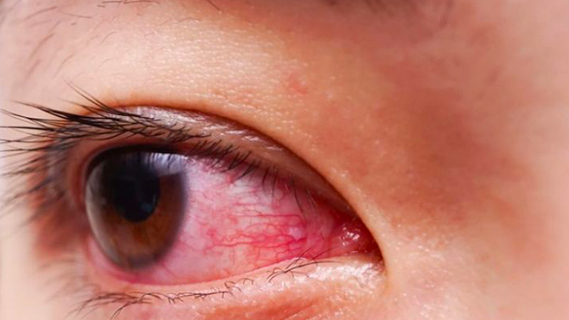 Bệnh đau mắt đỏ lây lan như thế nào và cách phòng ngừa 1