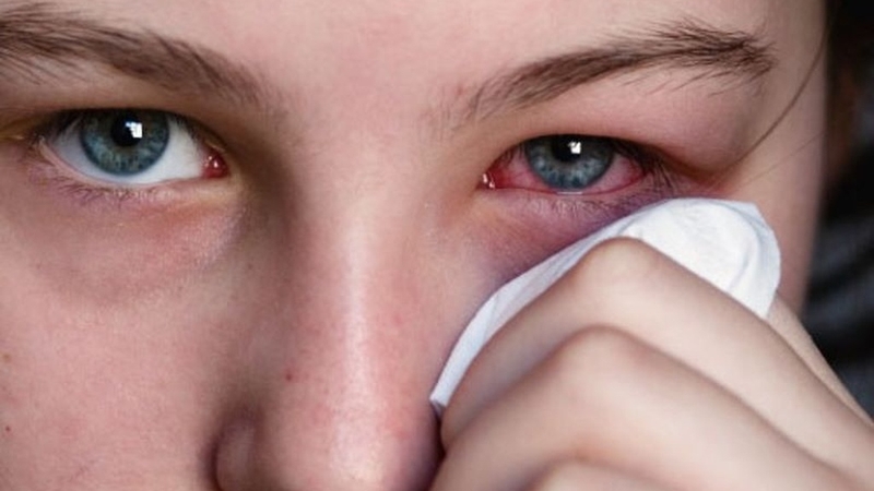 Bệnh đau mắt đỏ lây lan như thế nào và cách phòng ngừa 3