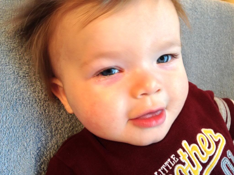 Bệnh đau mắt đỏ ở trẻ em và cách điều trị