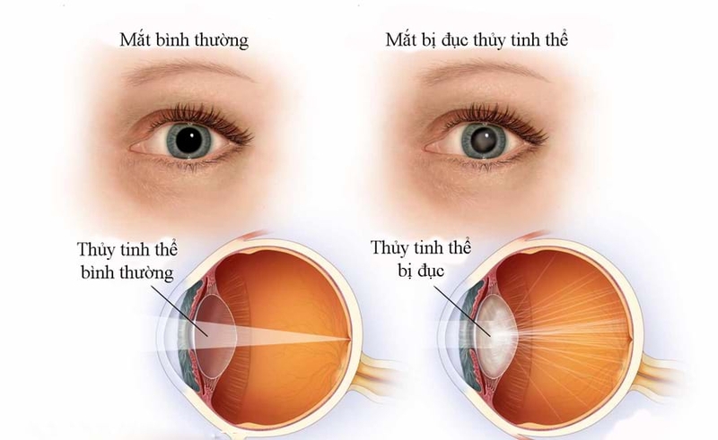 Bệnh đau mắt trắng nguy hiểm hơn nhiều so với đau mắt đỏ