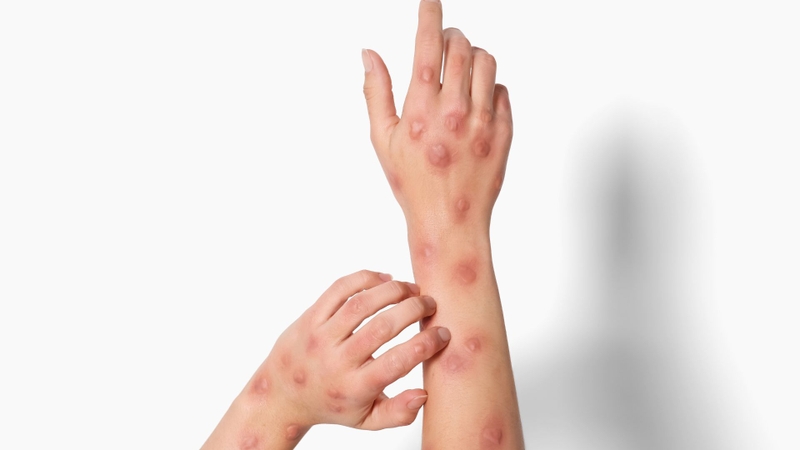 Bệnh đậu mùa khỉ lây qua đường nào? Giải thích chi tiết để chủ động phòng tránh 1