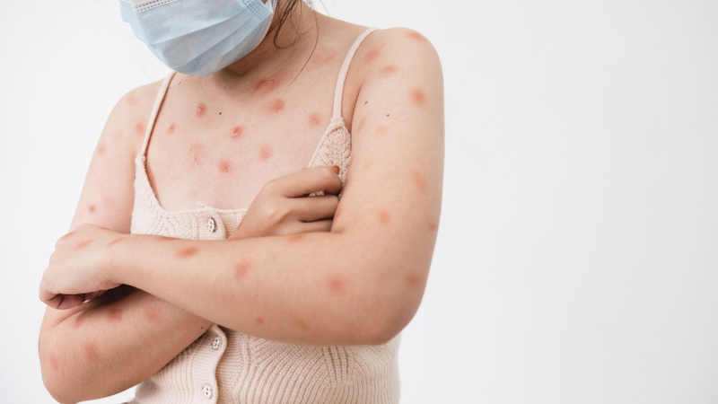 Bệnh đậu mùa khỉ lây qua đường nào? Giải thích chi tiết để chủ động phòng tránh 2