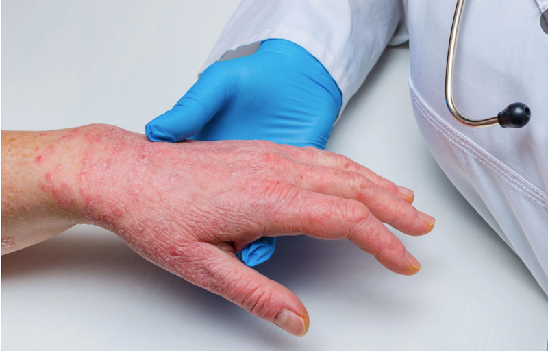 Bệnh đậu mùa khỉ ở Việt Nam và những điều bạn nên biết4