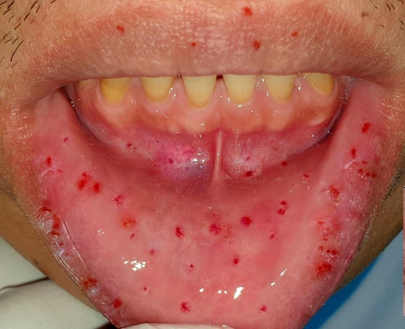 Bệnh di truyền hiếm gặp: Giãn mao mạch bẩm sinh xuất huyết 3