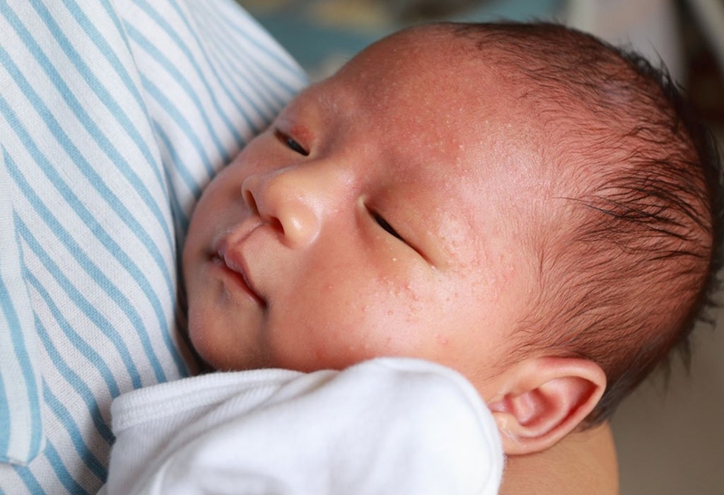 Đi tìm đáp án cho căn bệnh dị ứng bẩm sinh