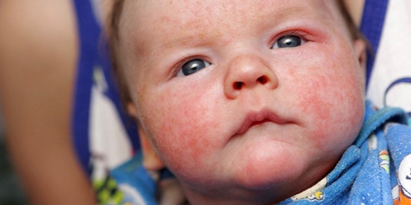 Phương pháp điều trị bệnh dị ứng cơ địa ở trẻ nhỏ 2