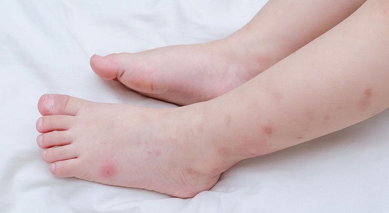 Kinh nghiệm từ chuyên gia để điều trị bệnh dị ứng côn trùng 1