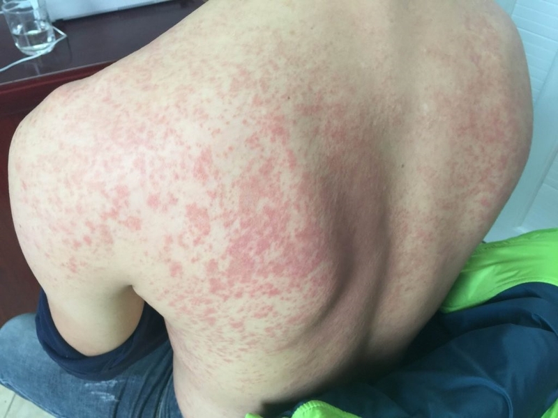 Điểm mặt các nguyên nhân gây bệnh dị ứng khắp người 1