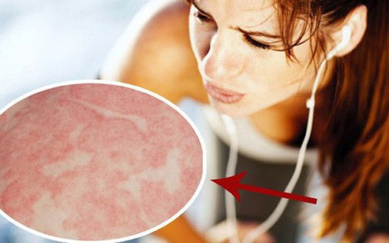 Những bệnh dị ứng kì lạ nhất mà có thể bạn chưa hề nghe qua 3