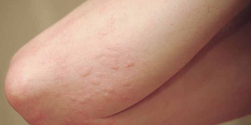 Giải quyết nỗi sợ hãi bệnh dị ứng mẩn ngứa 1