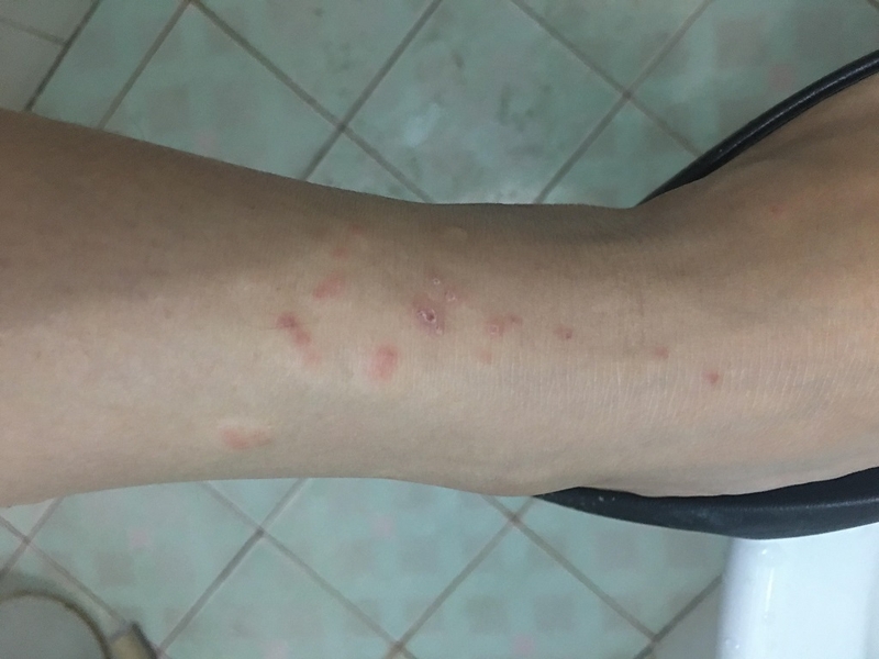 Bạn đã biết những nguyên nhân bệnh dị ứng ngoài da chưa 1