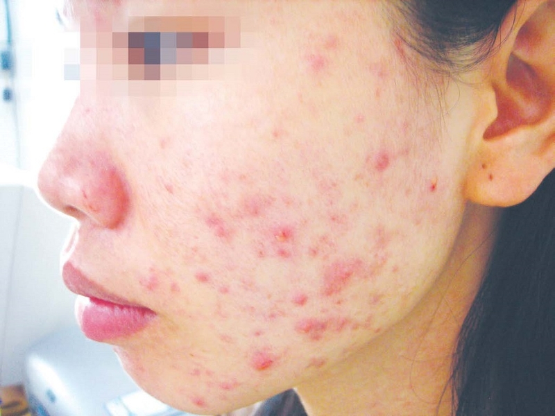 Nguyên nhân và dấu hiệu bệnh dị ứng nhiễm trùng 1