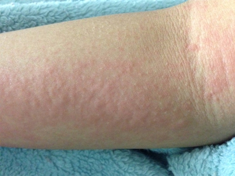 Cách trị bệnh dị ứng nổi mẩn ngứa hiệu quả