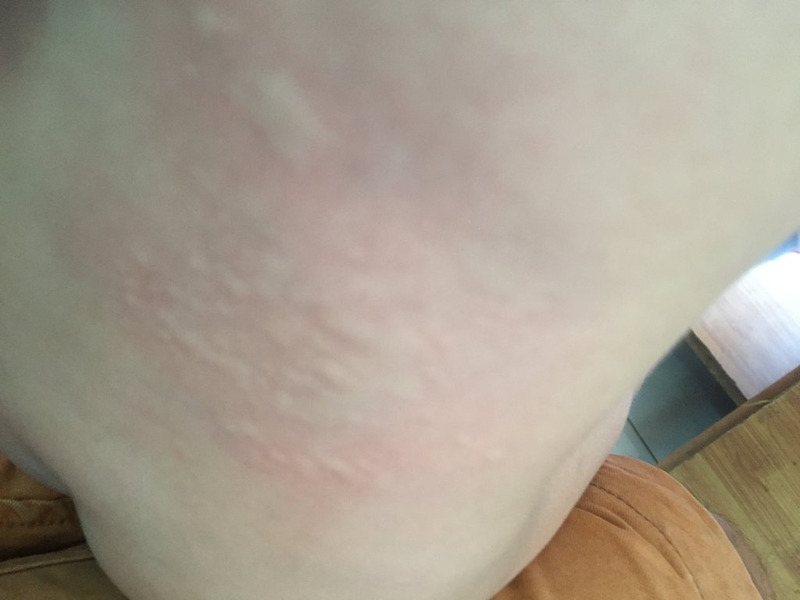 Phương pháp trị bệnh dị ứng nổi mề đay đơn giản 2