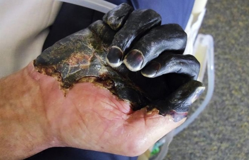 benh-dich-hach-co-chua-duoc-khong-nhung-dieu-can-biet-ve-benh-dich-hach 3