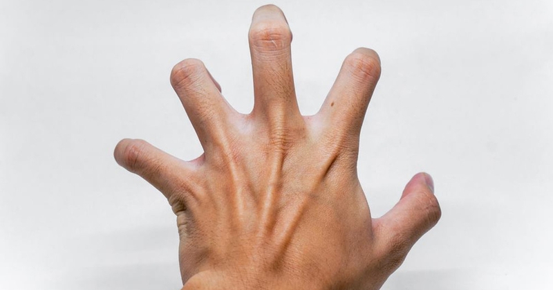 Bệnh động kinh ở trẻ có chữa được không 3