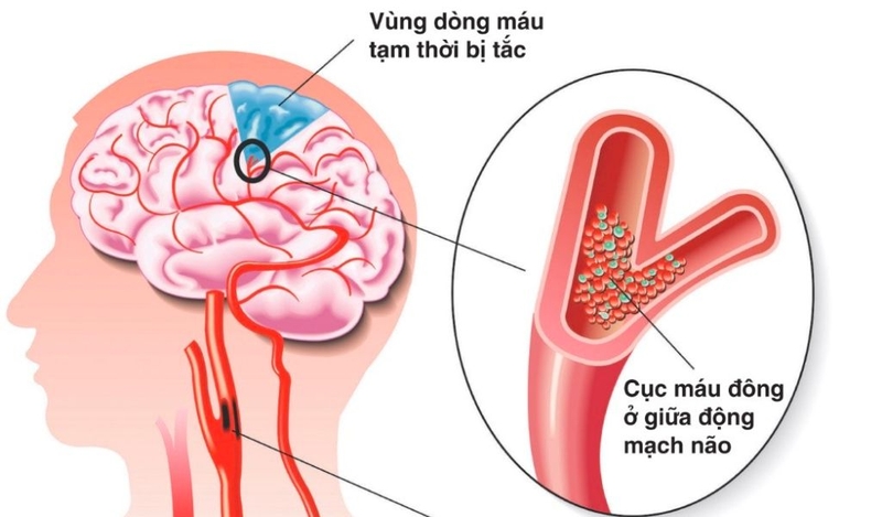 Bệnh động mạch cảnh là gì? Dự phòng và điều trị? 1