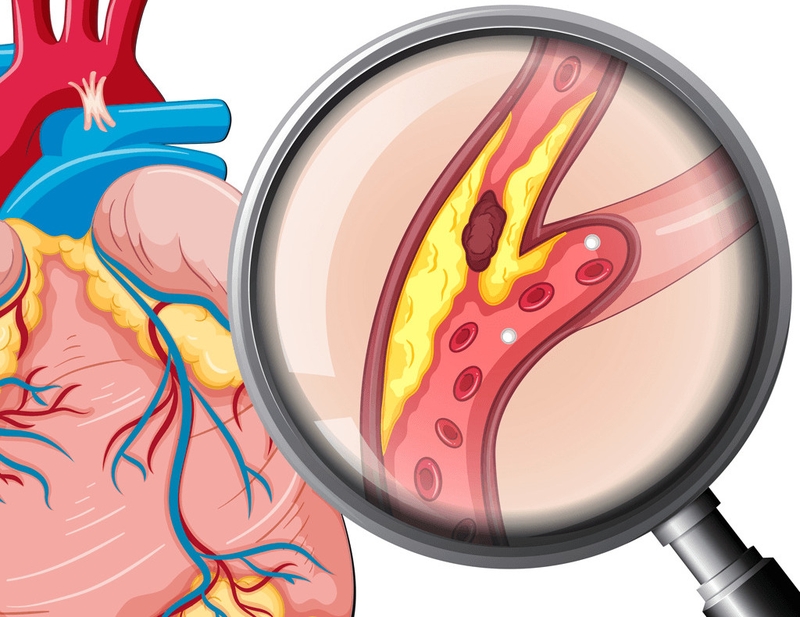 Bệnh động mạch chủ: Biểu hiện, điều trị và biện pháp phòng ngừa 1