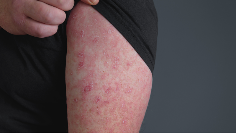 Bệnh Erysypelas là gì? 1