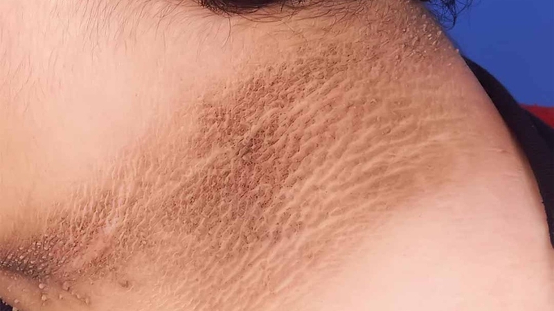 Bệnh gai đen ở người béo phì và những điều bạn cần biết 2