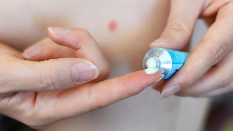 Bệnh ghẻ có lây không? Dấu hiệu nhận biết và cách phòng ngừa hiệu quả 4