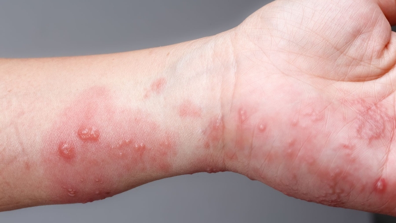 Bệnh ghẻ nước là gì? Nguyên nhân, dấu hiệu và cách điều trị hiệu quả 3