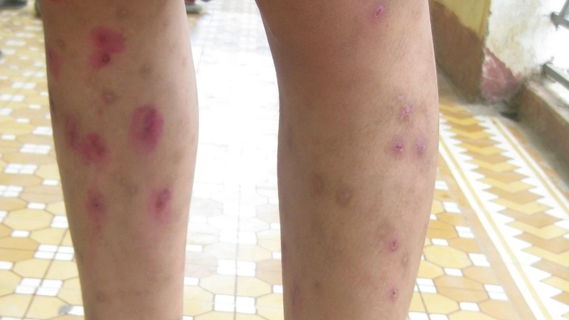 Bệnh ghẻ ở trẻ em: Nguyên nhân, triệu chứng và điều trị bệnh 1