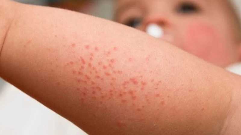 Bệnh ghẻ ở trẻ em: Nguyên nhân, triệu chứng và điều trị bệnh 2