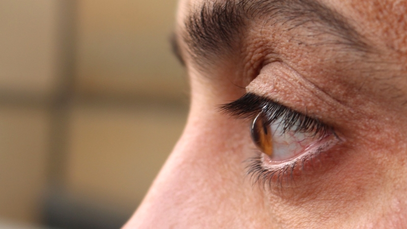 Bệnh giác mạc hình chóp có nguy hiểm không? Những điều bạn cần biết để bảo vệ thị lực 2