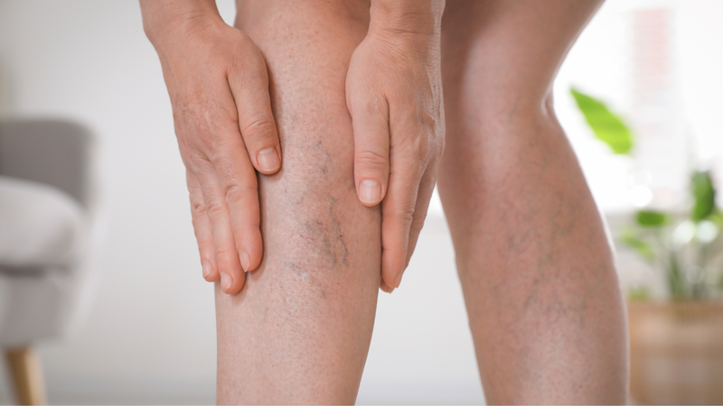 Bệnh giãn tĩnh mạch chân có nguy hiểm không? Tùy tình trạng bệnh của mỗi người