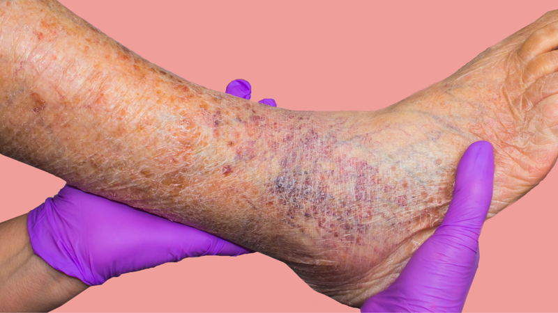 Nếu không chăm sóc và điều trị đúng sẽ gây biến chứng nghiêm trọng