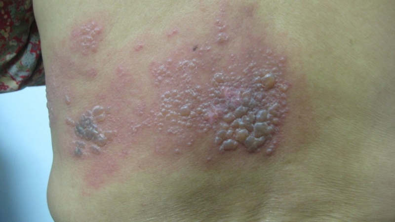 Bệnh giời leo kéo dài bao lâu thì khỏi?