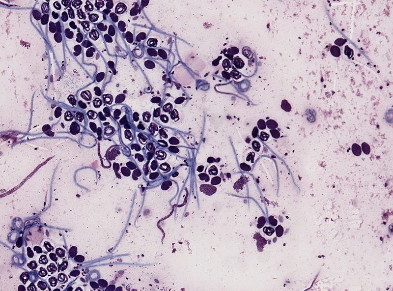 Bệnh giun chỉ&nbsp;Onchocerca&nbsp;lây lan bởi ruồi đen Simulium&nbsp;phát triển trong dòng suối chảy nhanh