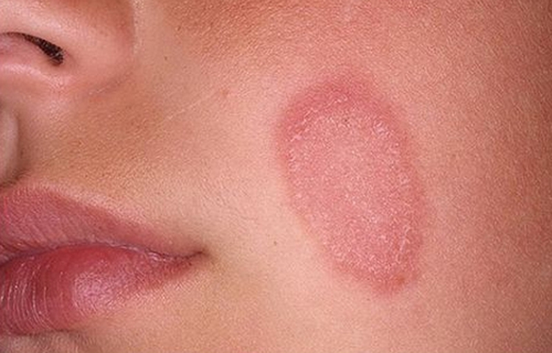Bệnh hắc lào ở mặt và phương pháp chữa tại nhà 1