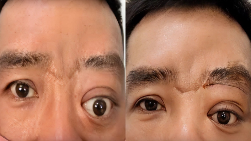 Bệnh nhân được chẩn đoán mắc bệnh hiếm u nhầy xoang trán trái lan vào hốc mắt