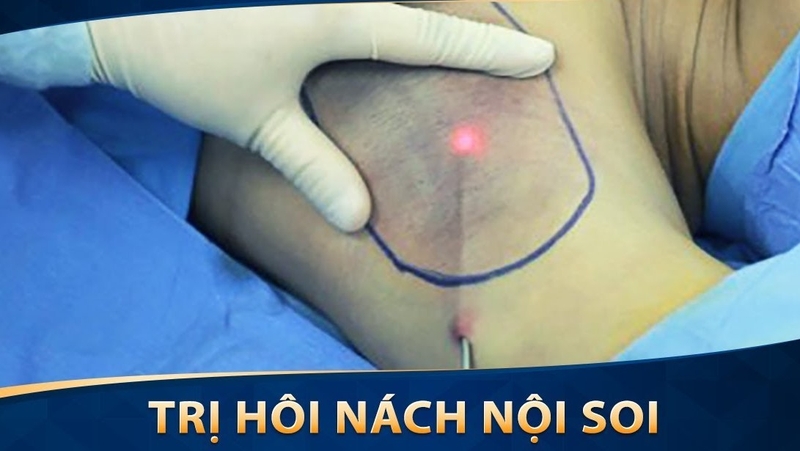 Bệnh hôi nách giặt chung quần áo có lây không? 4