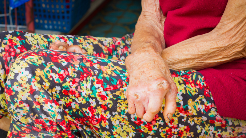 Bệnh hủi là gì? Nguyên nhân và dấu hiệu nhận biết 2