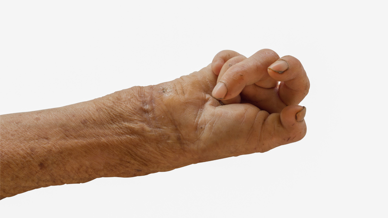 Bệnh hủi là gì? Nguyên nhân và dấu hiệu nhận biết 1