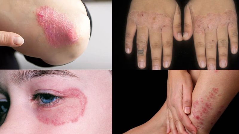 Bệnh lác đồng tiền có lây không? Cách phòng ngừa hiệu quả 2