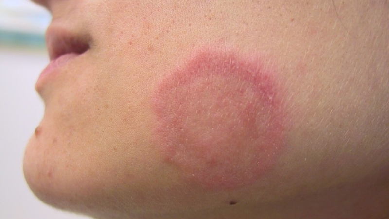 Sử dụng thuốc trị nấm điều trị bệnh lác đồng tiền