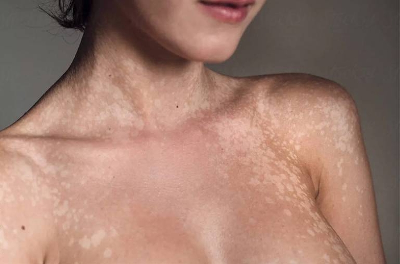 Lang ben rất dễ lây lan từ người bệnh sang người lành