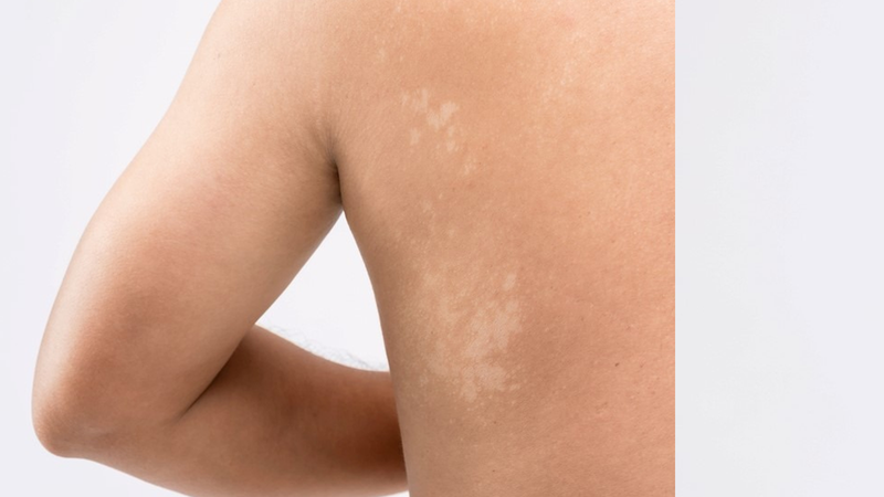 Bệnh lang ben có tự khỏi không là thắc mắc chung