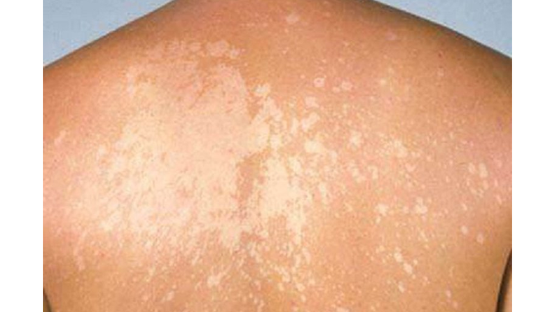 Lang ben là bệnh nấm ngoài da