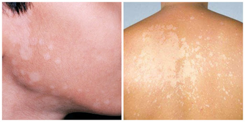 Nguyên nhân, dấu hiệu và cách điều trị bệnh lang beng nâu 1