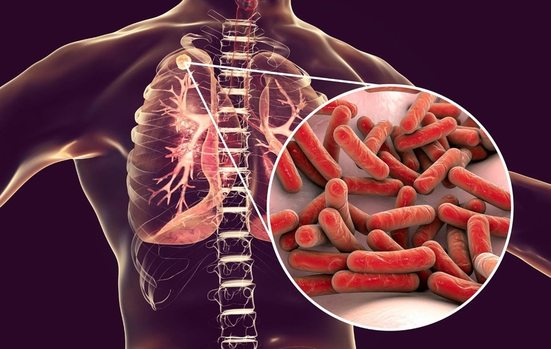 Bệnh lao có di truyền không? Làm thế nào ngăn ngừa lây nhiễm bệnh lao? 1