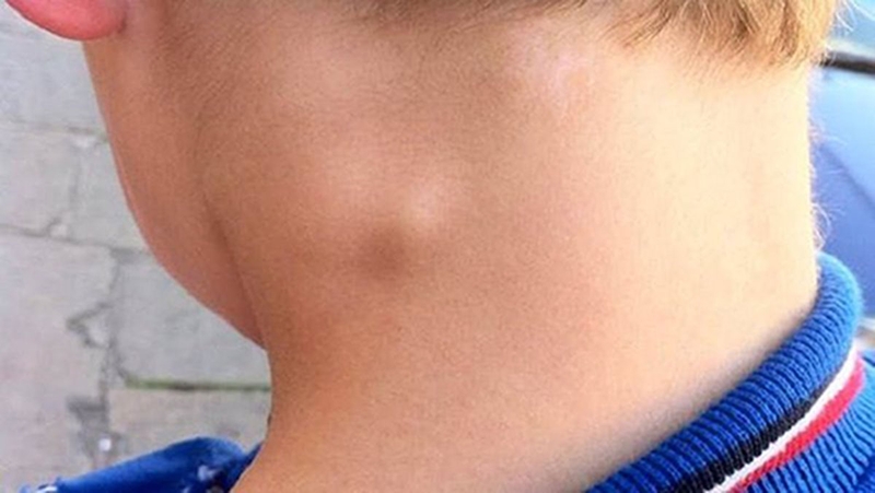 Bệnh lao hạch: Nguyên nhân, triệu chứng và cách điều trị 1